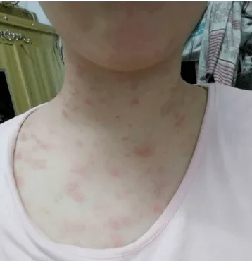玫瑰糠疹