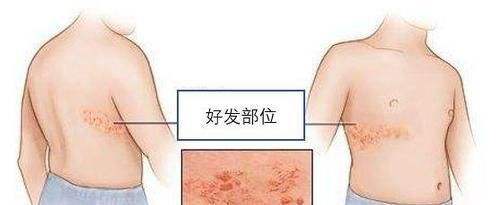 带状疱疹