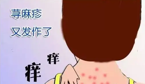 荨麻疹